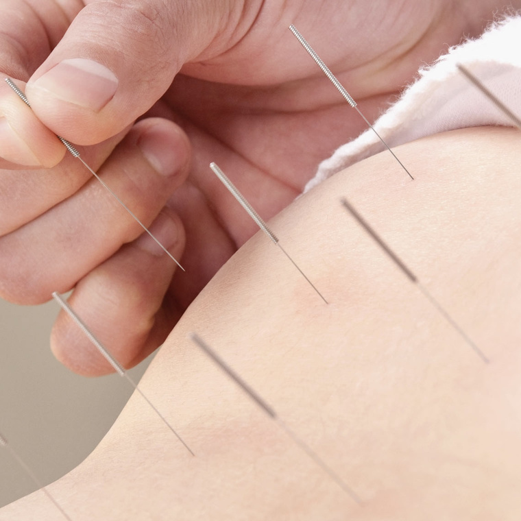 acupuncture physiotherapy